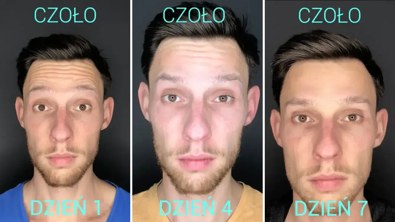 Przed i po baby botoks na czole. Dzień 1: widoczne zmarszczki. Dzień 4 i 7: wygładzone czoło.