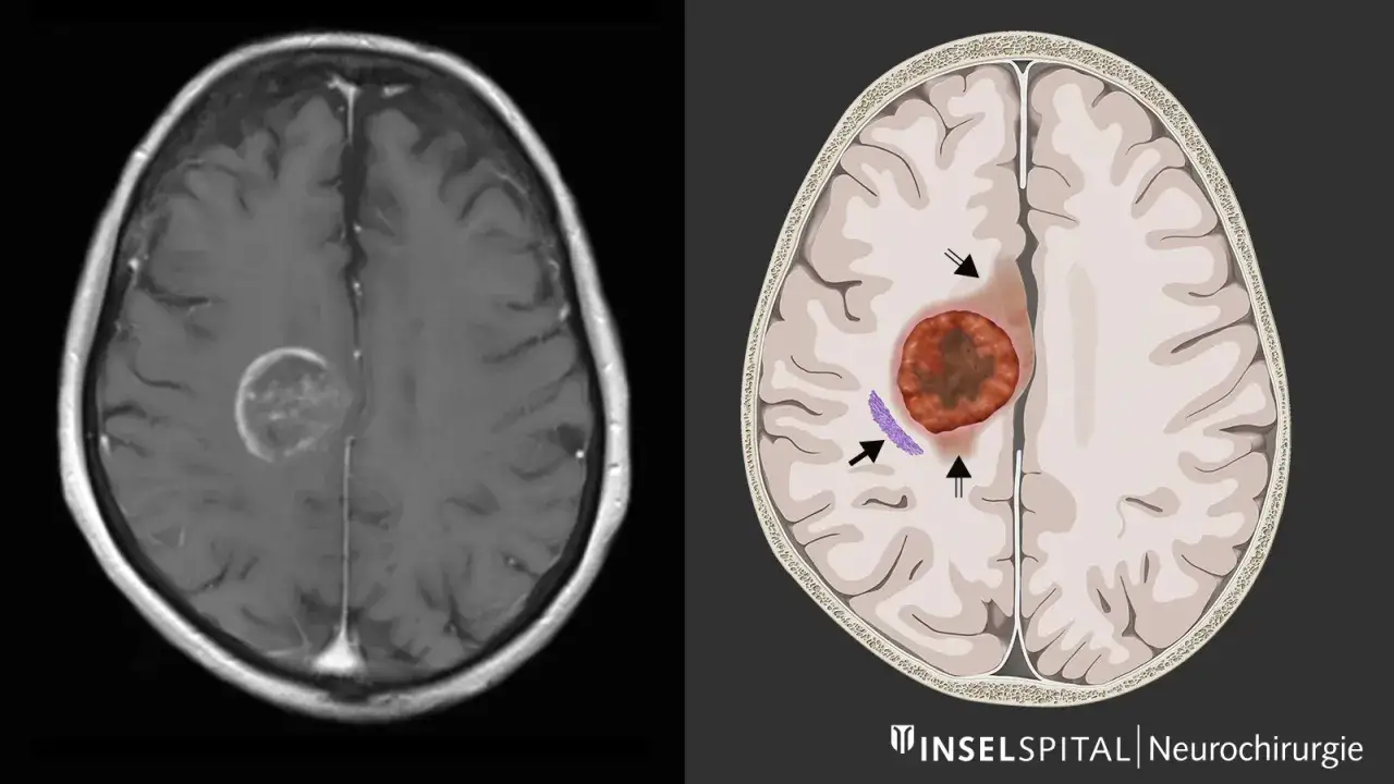 MRT-Aufnahme und schematische Darstellung eines gutartigen Hirntumors im Gehirn.