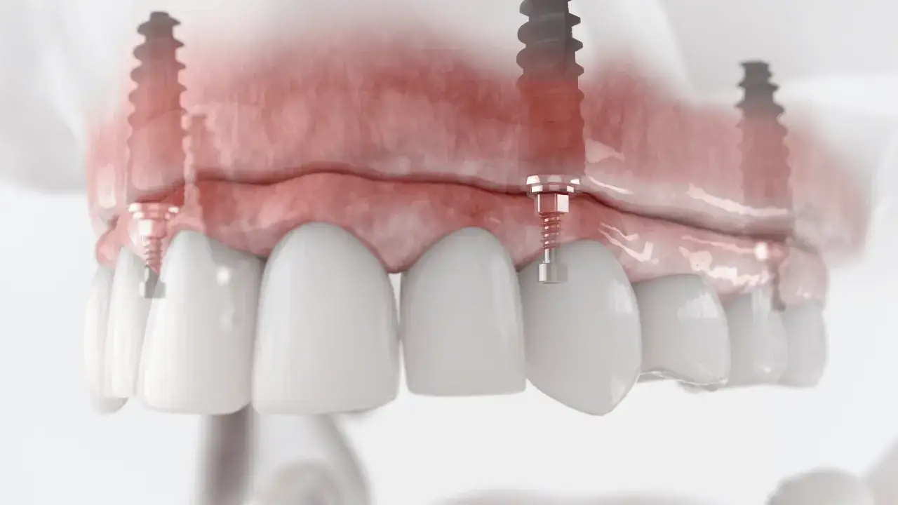 Model szczęki z implantami. Widoczne są białe zęby, różowe dziąsła i wszczepione implanty. Procedura sinus lift pozwala na odbudowę kości.