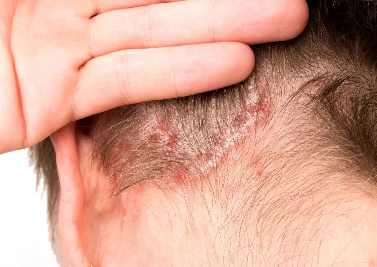 Una mano cubre parte de la cabeza, revelando escamas blancas y enrojecimiento en el cuero cabelludo, indicando picor en la cabeza.