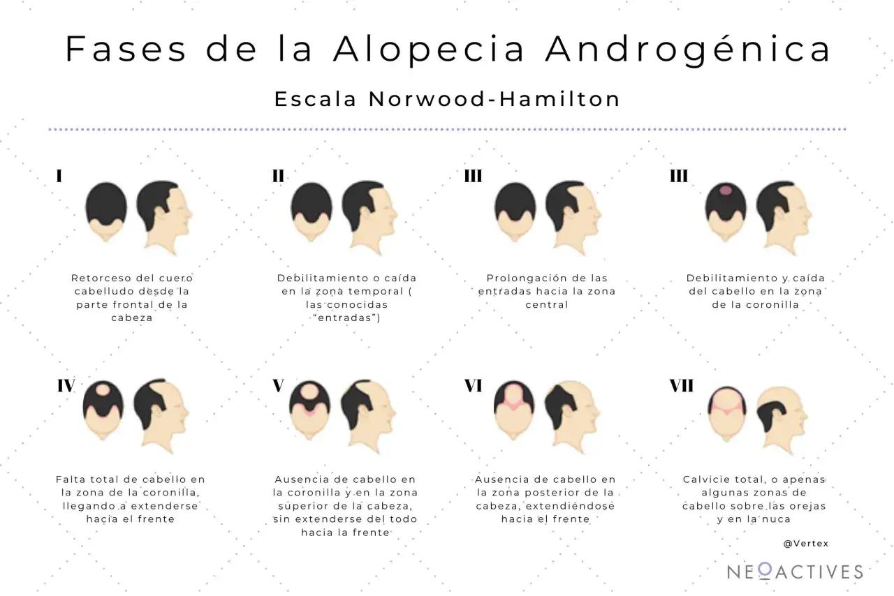 Ilustraci&oacute;n de las fases de la alopecia androg&eacute;nica, mostrando la p&eacute;rdida de cabello y c&oacute;mo la 5 alfa reductasa afecta el pelo.