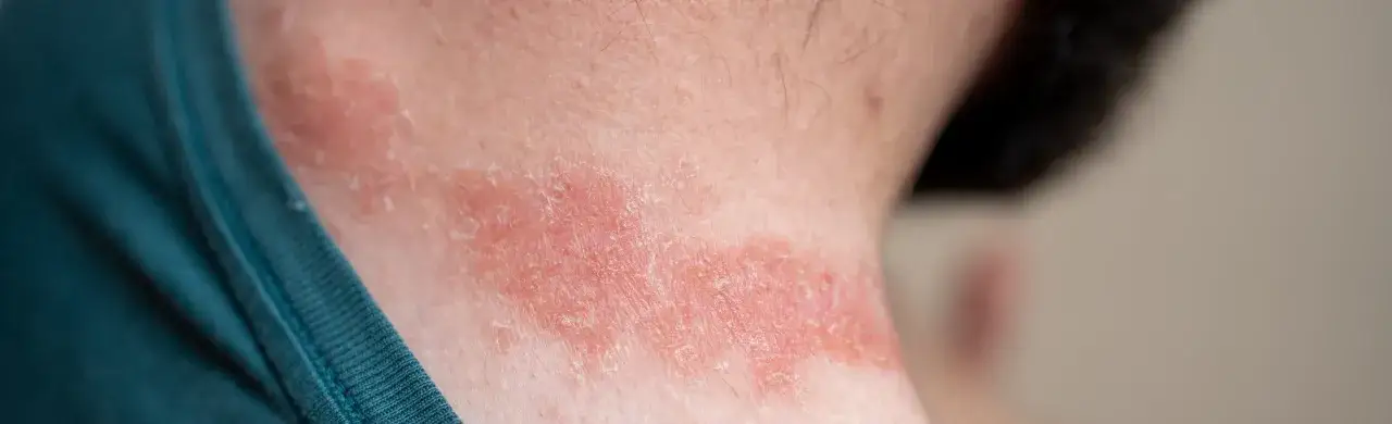 Irritation cutanée rouge et squameuse sur le cou, possiblement due à une allergie à l'eau calcaire.