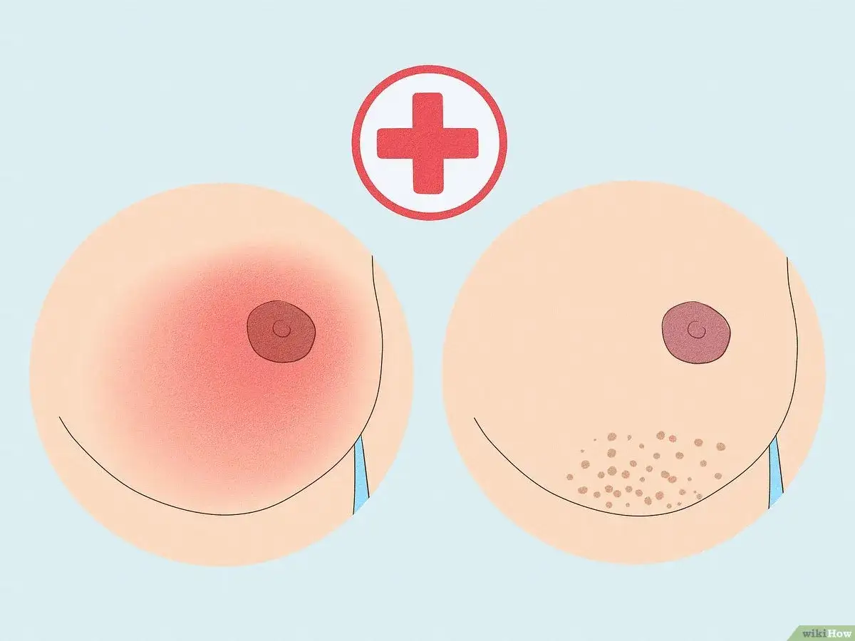 Comparaison de deux seins : l'un rouge et irrit&eacute;, l'autre avec des points, peut-&ecirc;tre un t&eacute;ton qui gratte.
