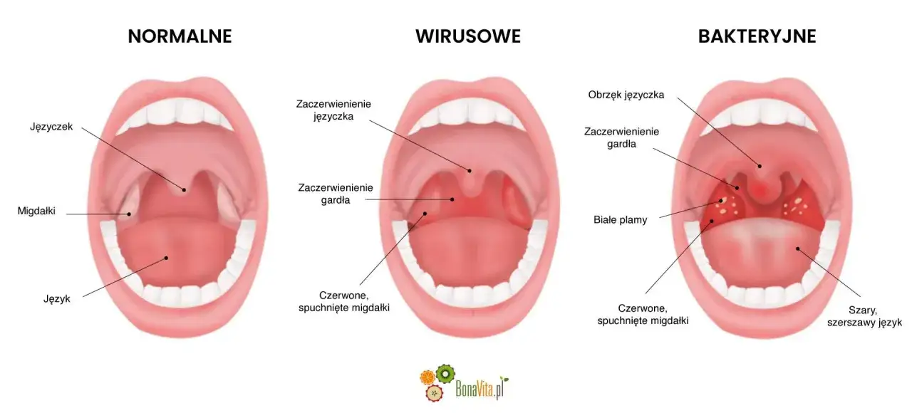 Porównanie gardła: normalne, wirusowe (zaczerwienienie, obrzęk języczka) i bakteryjne (białe plamy na migdałkach, afta na migdale).