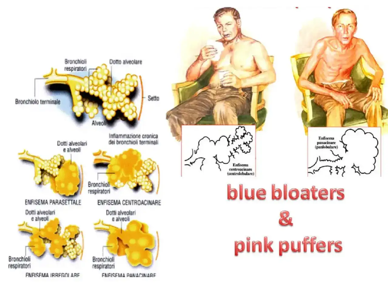 Darstellung von COPD-Formen: 