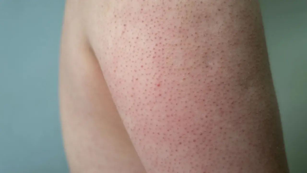 Närbild på hud med små röda prickar, typiskt för keratosis pilaris hos barn.