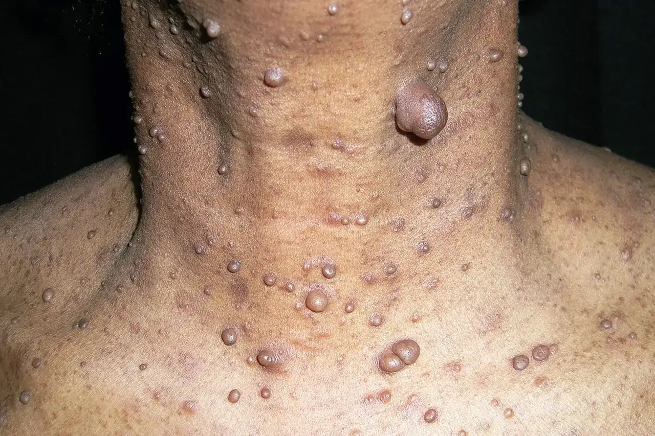 Skóra szyi i klatki piersiowej pokryta licznymi, różnej wielkości guzkami, co jest charakterystyczne dla neurofibromatozy.