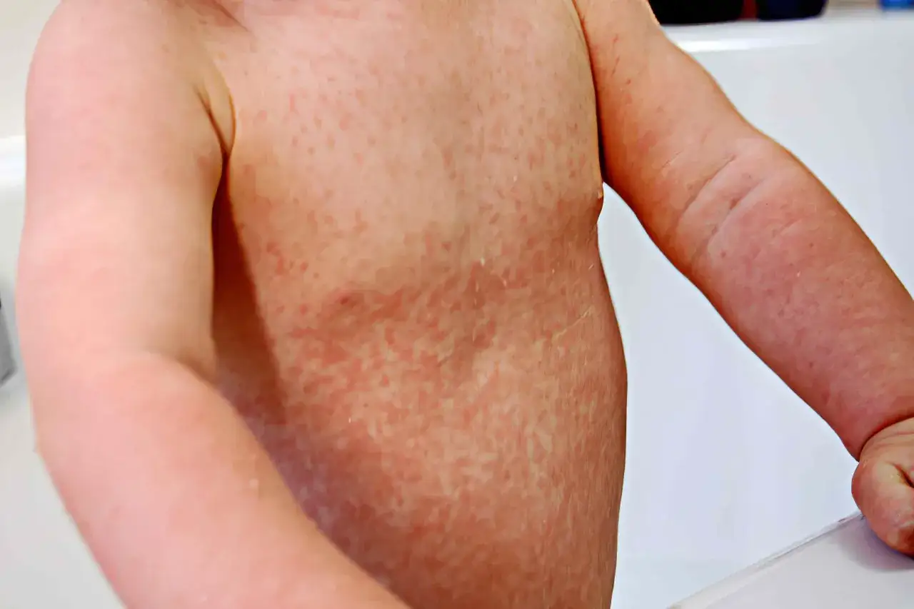 Torace e braccia di un bambino ricoperti da piccole macchie rosse, indicative di orticaria papulosa.