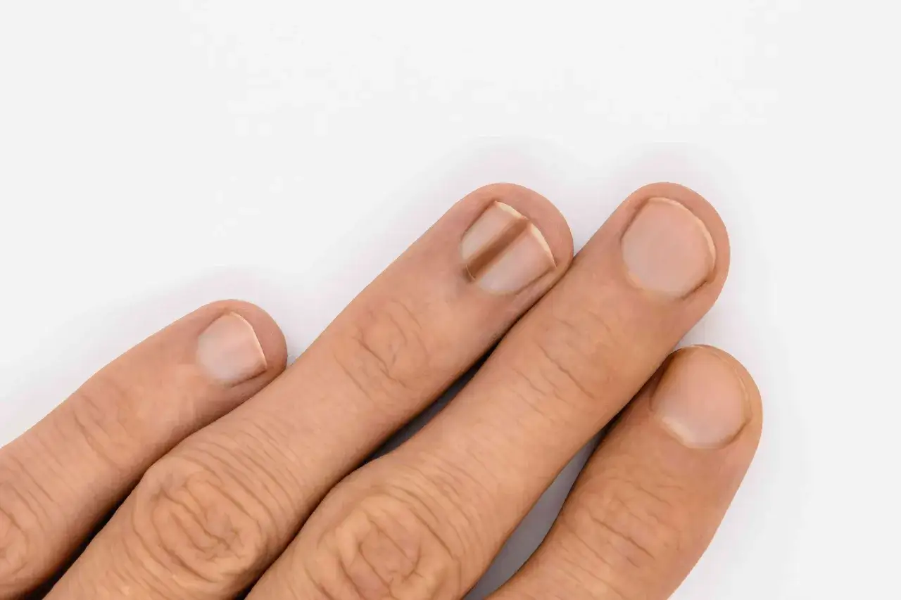 Un ongle pr&eacute;sente un trait noir, possible signe d'une carence en fer.