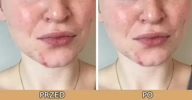 Zdjęcie Peeling z retinolem: opinie, efekty i skutki uboczne zabiegu