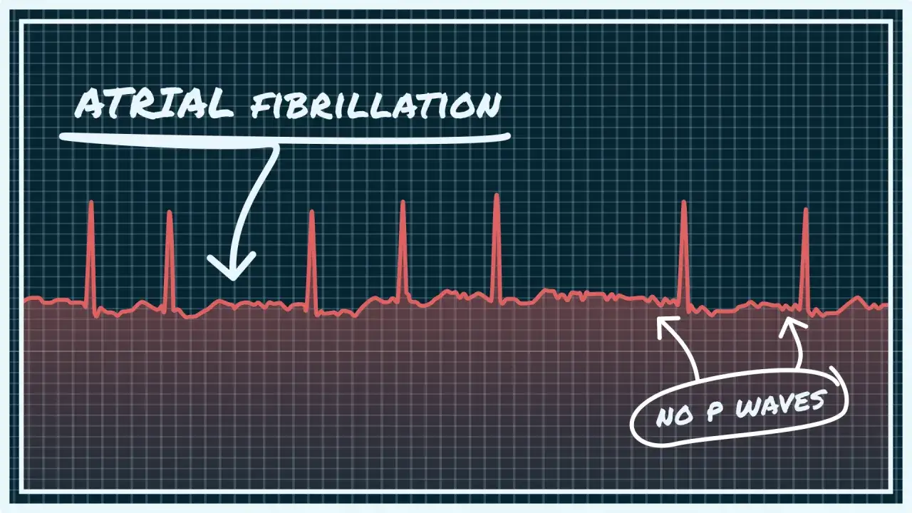 Nieregularny rytm serca, widoczny na EKG jako migotanie przedsionków, charakteryzuje się brakiem fal P.