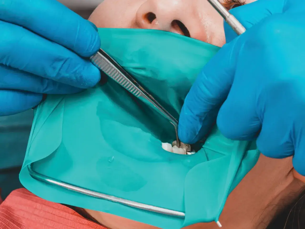 Dentysta w niebieskich rękawiczkach używa narzędzi do pracy przy zębach pacjenta, izolowanych za pomocą koferdamu.