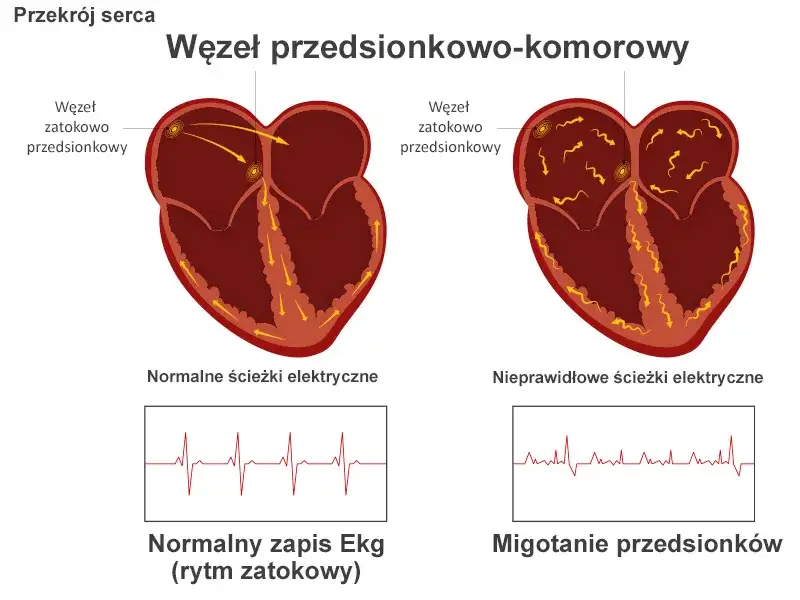 Serce migotanie przedsionków schemat
