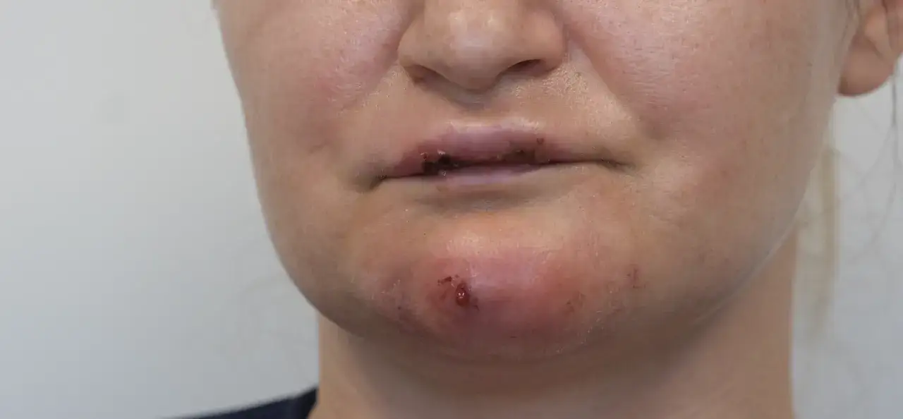 Obrzęk i zaczerwienienie na brodzie, z widocznym ropniem, oraz podrażnione usta. Stan zapalny po niciach PDO.
