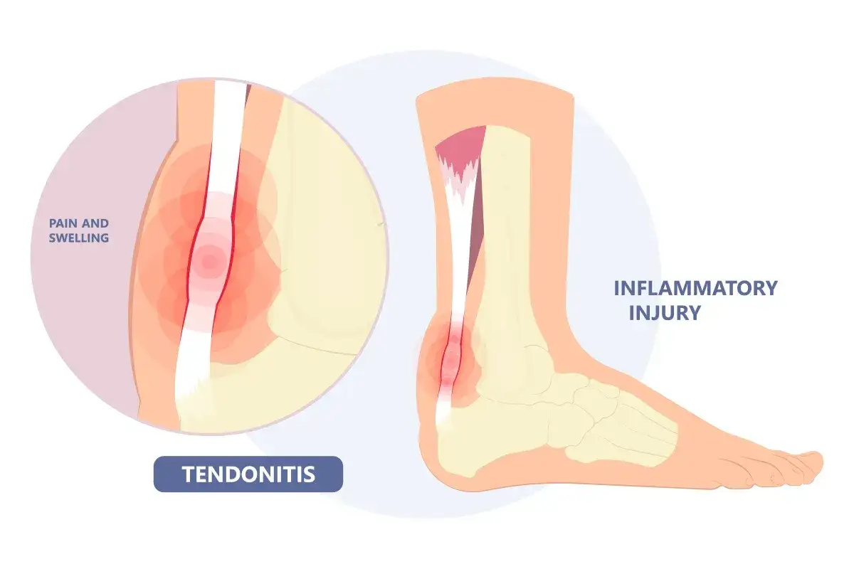 Illustration d'une tendinite à la cheville, montrant douleur et gonflement. L'ibuprofène peut aider à soulager cette blessure inflammatoire.