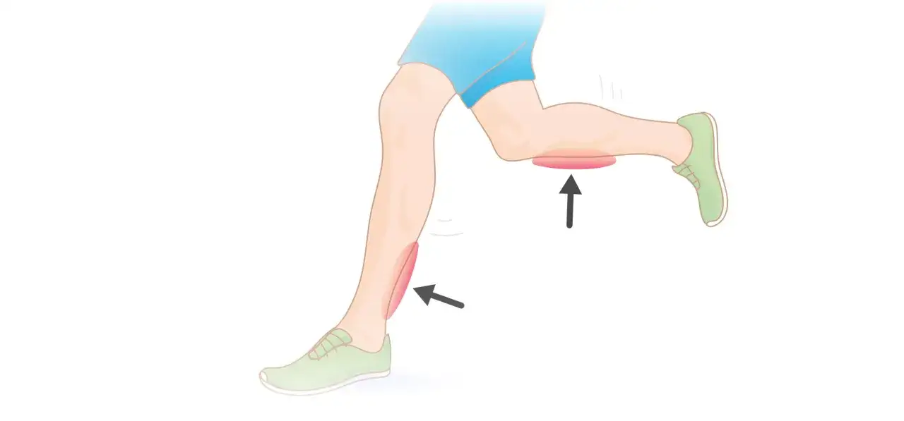 L&auml;ufer mit Schienbeinschmerzen (shin splint). Pfeile zeigen auf entz&uuml;ndete Bereiche am Unterschenkel und Oberschenkel.