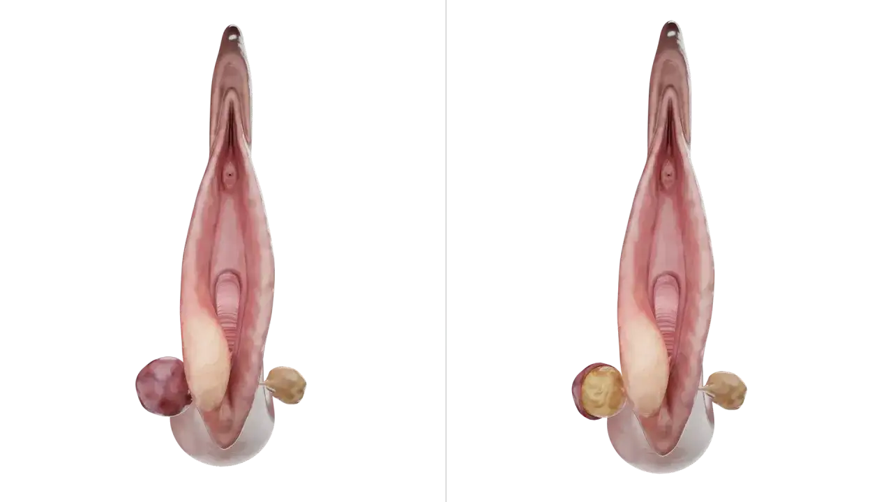 Ilustracja przedstawia anatomiczny przekrój narządów rodnych kobiety, uwidaczniając zapalenie gruczołu Bartholina jako powiększoną, zaczerwienioną strukturę.