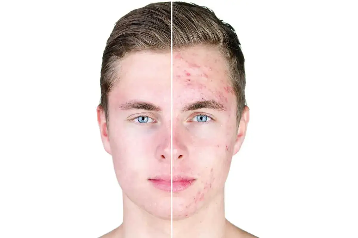 rosazea gesicht symptome oder periorale dermatitis symptome