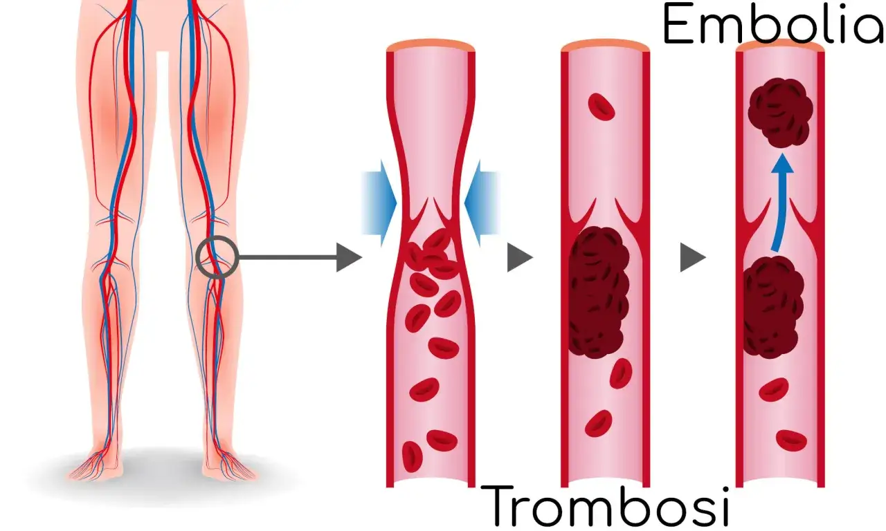 Illustrazione della trombosi venosa profonda: un coagulo blocca il flusso sanguigno, causando un calore improvviso alle gambe e potenziale embolia.