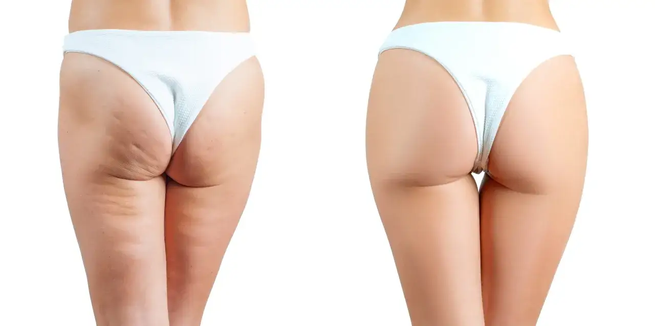 Comparaison avant/après : réduction visible de la cellulite sur les fesses. Peau lisse et tonique.