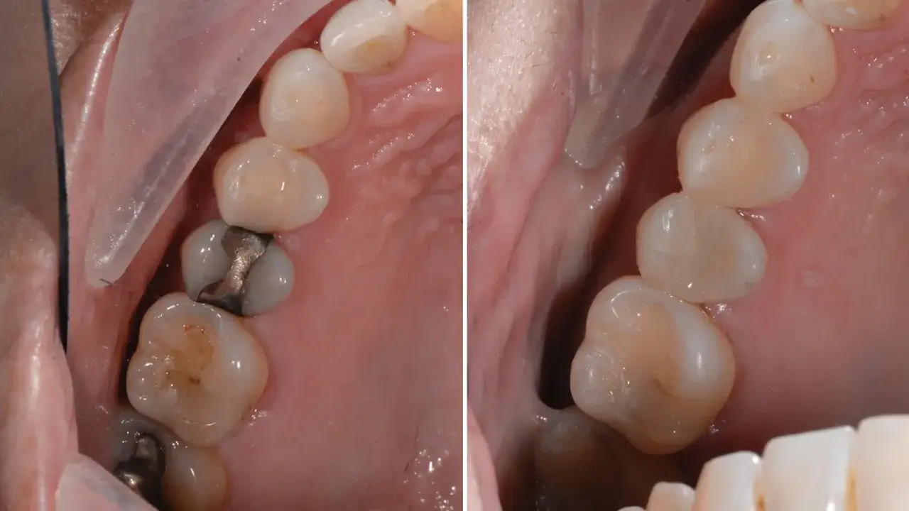 Confronto tra otturazioni in resina e metallo. I denti in resina quanto durano? La risposta varia, ma la cura è fondamentale.