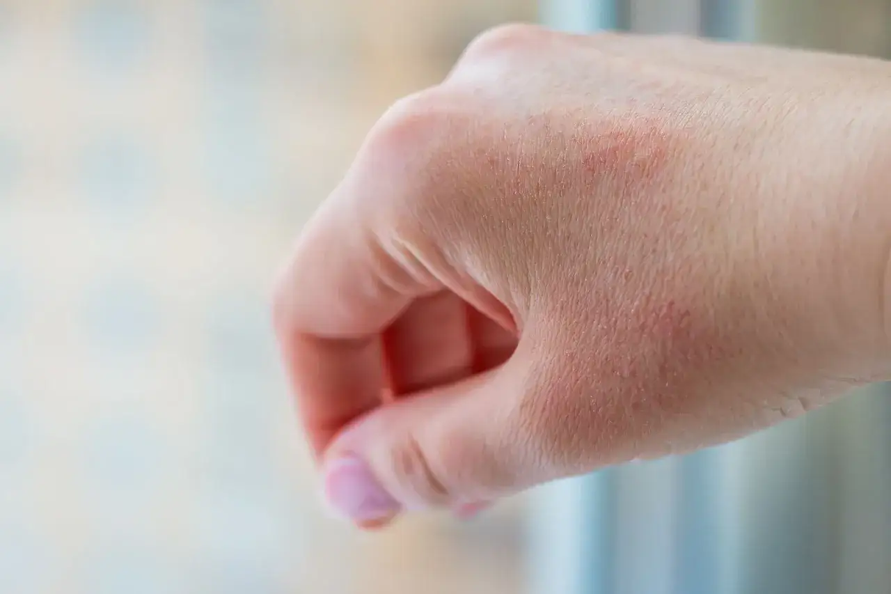 Dłoń z zaczerwienioną, suchą skórą, objaw uczulenia na zimno.