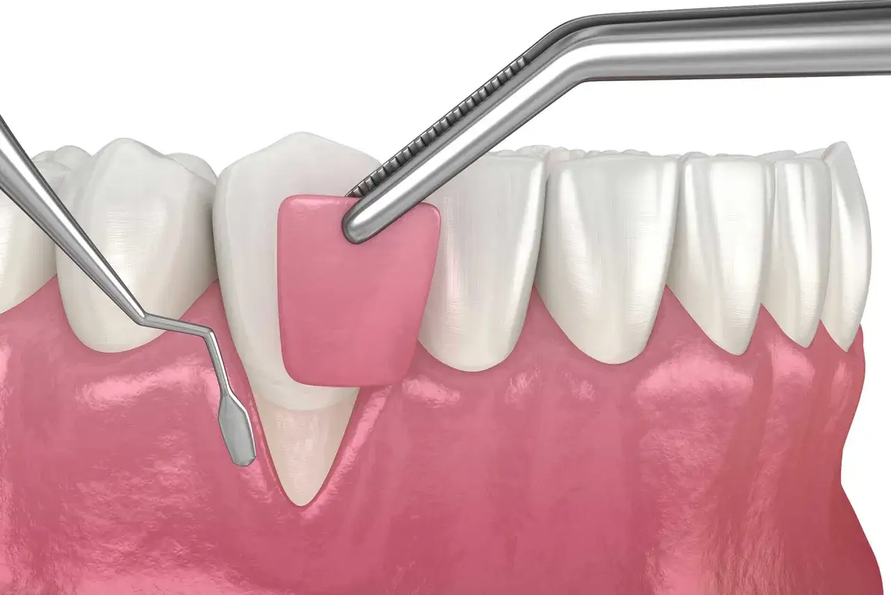 Procedimiento dental para recuperar hueso encias. Se aplica un injerto de tejido gingival con instrumental especializado.