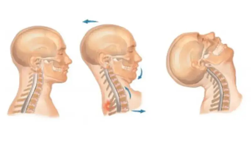 anatomia kręgosłupa szyjnego uraz skręcenie