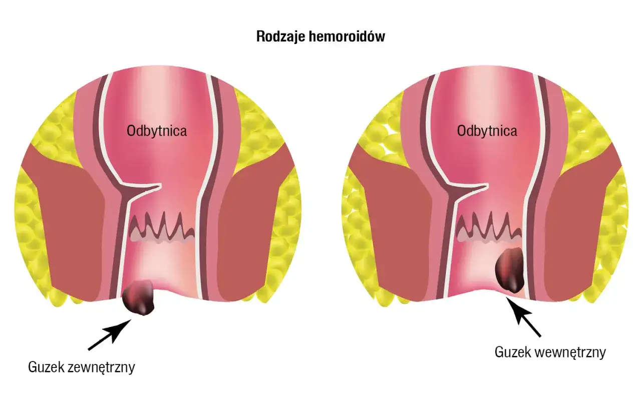 rodzaje hemoroidów wewnętrzne zewnętrzne diagram