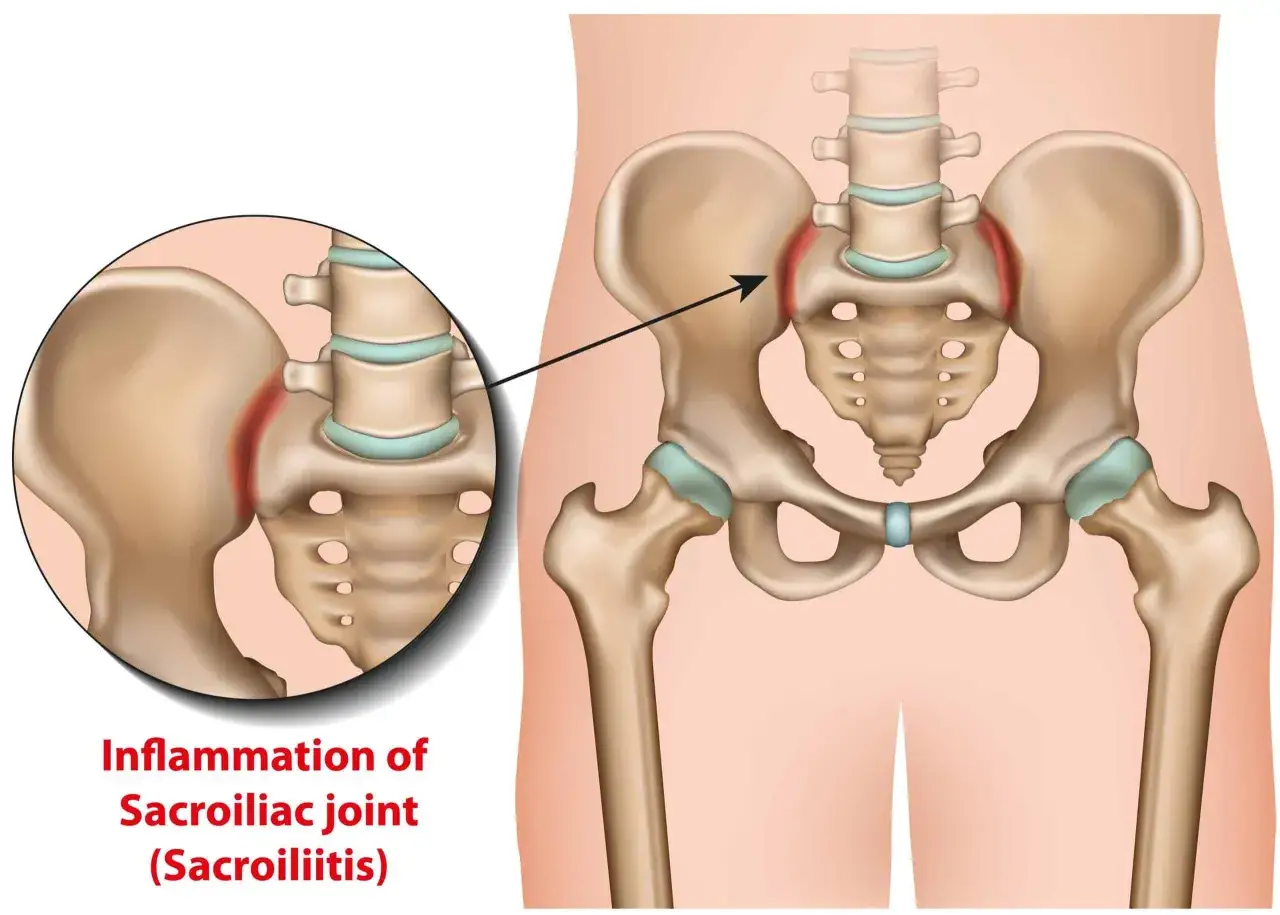 Zapalenie stawu krzyżowo-biodrowego (zzsk ile się żyje) - ilustracja anatomiczna miednicy z zaznaczonym stanem zapalnym.