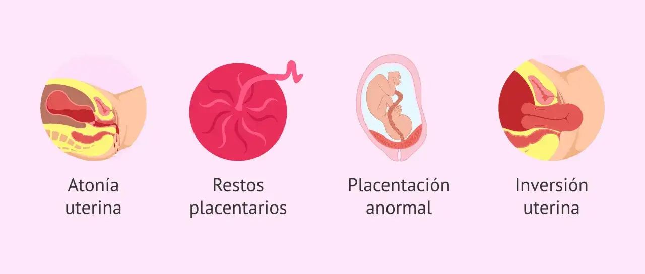 Ilustraciones de tipos de sangrado postparto: aton&iacute;a uterina, restos placentarios, placenta an&oacute;mala e inversi&oacute;n uterina.