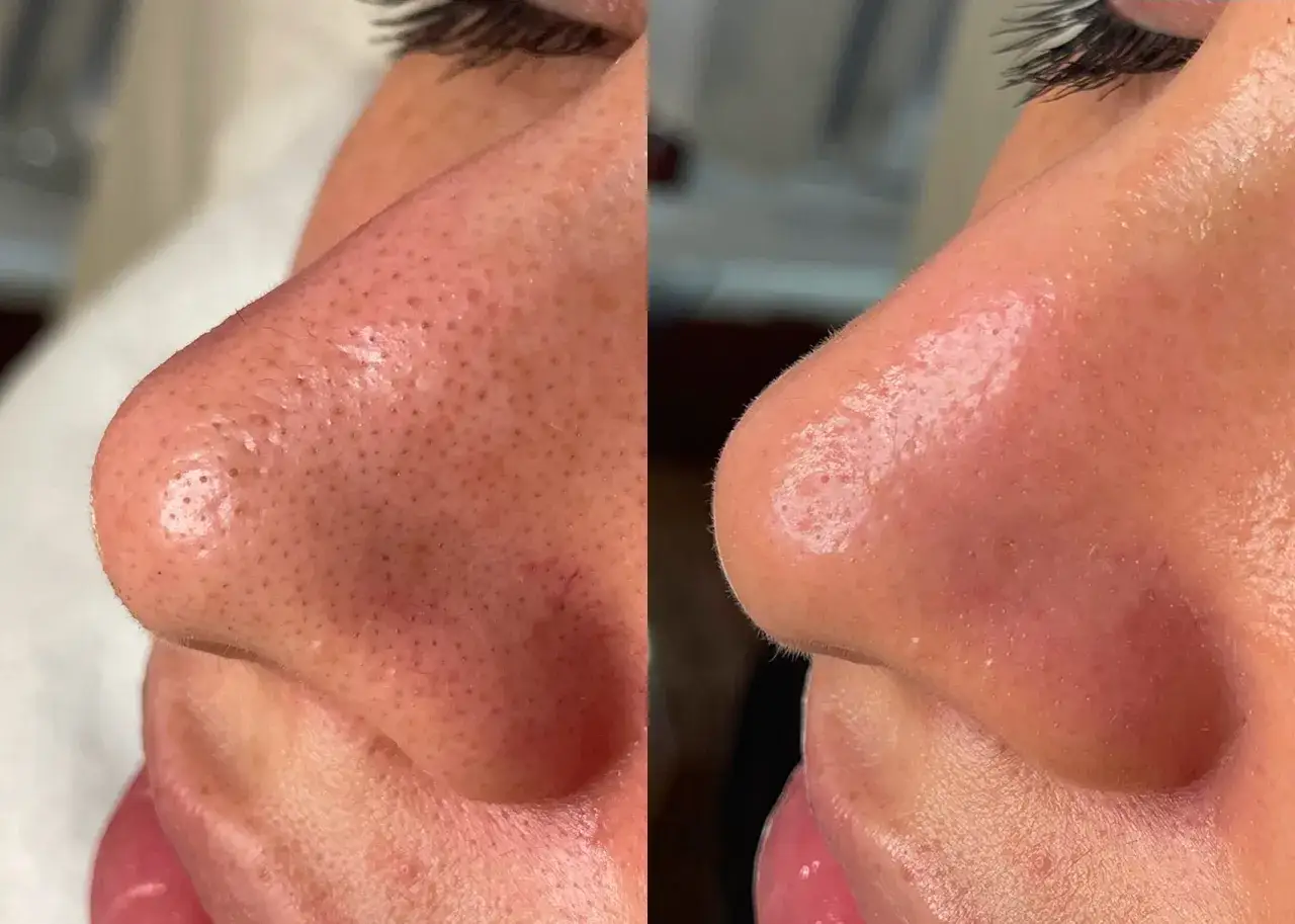 Antes y después de un hydrafacial que es un tratamiento para limpiar y revitalizar la piel, mostrando poros reducidos y una piel más suave.