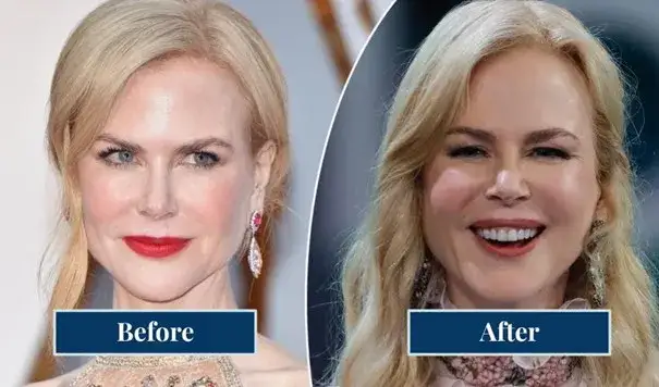 kobieta z efektem pillow face po zabiegu