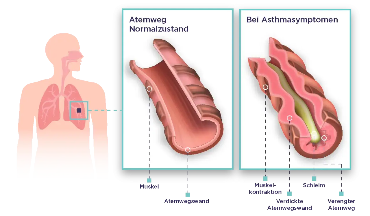 Vergleich von Atemwegen: Normalzustand vs. bei Asthmaanfall Symptome. Links ein offener, rechts ein verengter Atemweg mit Schleim und Muskelkontraktion.