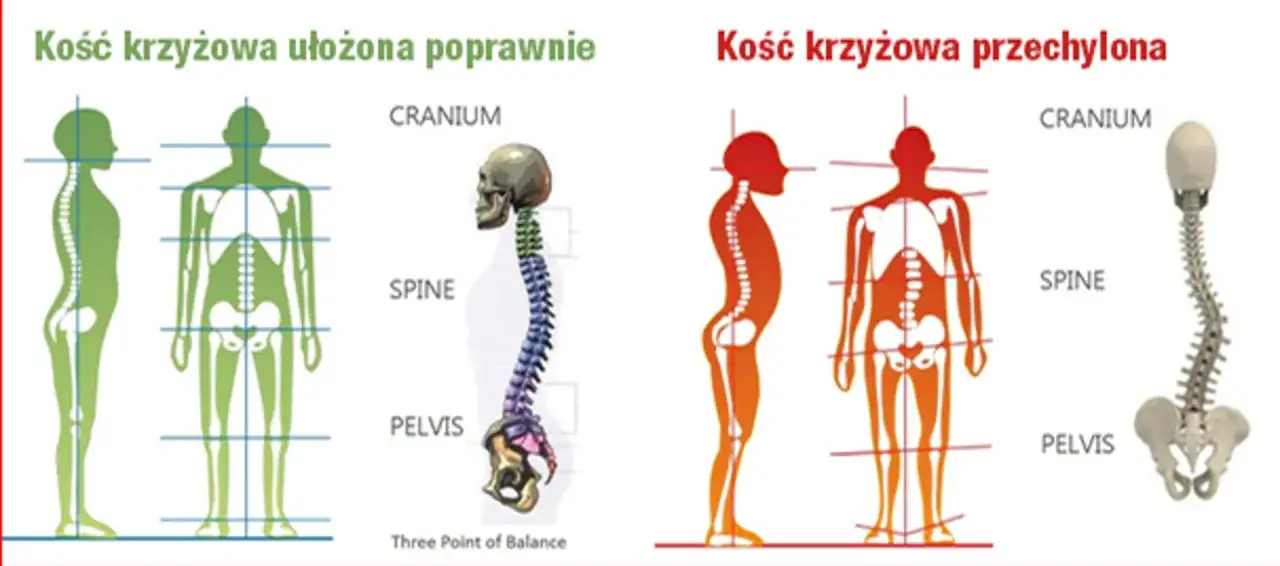 Porównanie prawidłowego i przechylonego ułożenia kości krzyżowej. Wady postawy mogą przypominać objawy rdzeniowego zaniku mięśni.