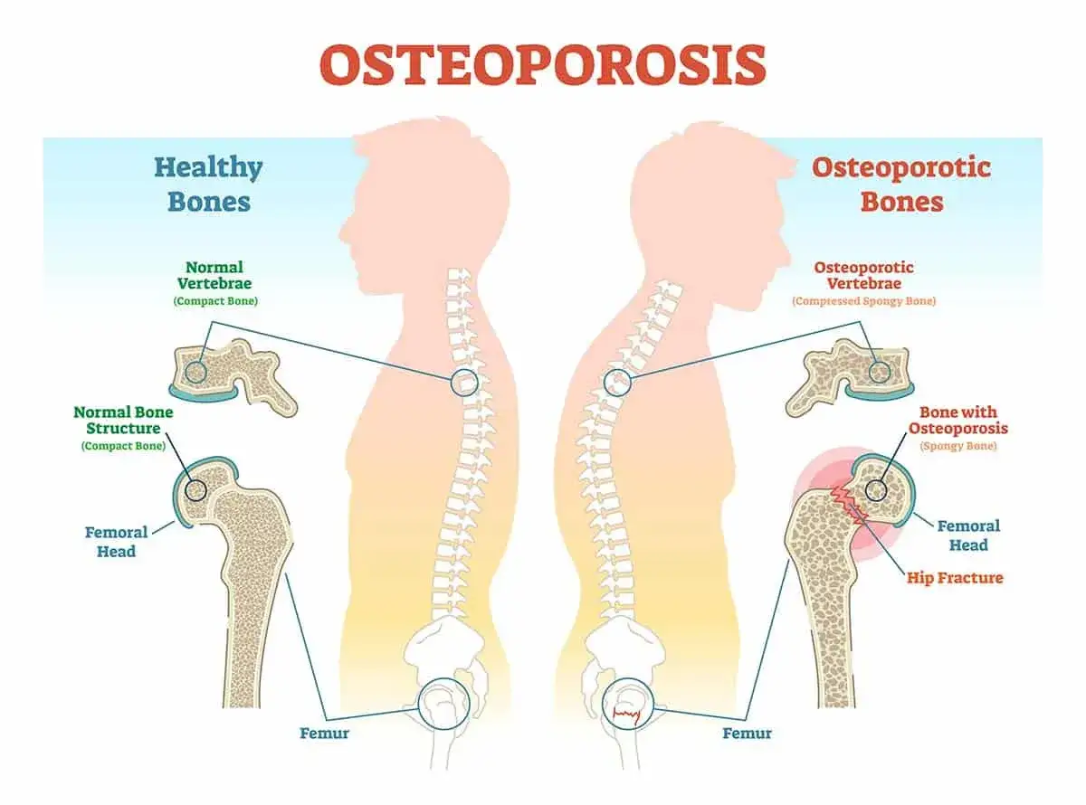 Vergleich gesunder und osteoporotischer Knochen. Zeigt komprimierte Wirbel und H&uuml;ftfrakturen. Die Frage, ob Osteoporose heilbar ist, wird durch diese Darstellung der Knochengesundheit thematisiert.