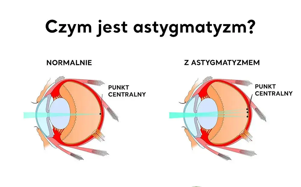 schemat oka z astygmatyzmem i okiem bez wady