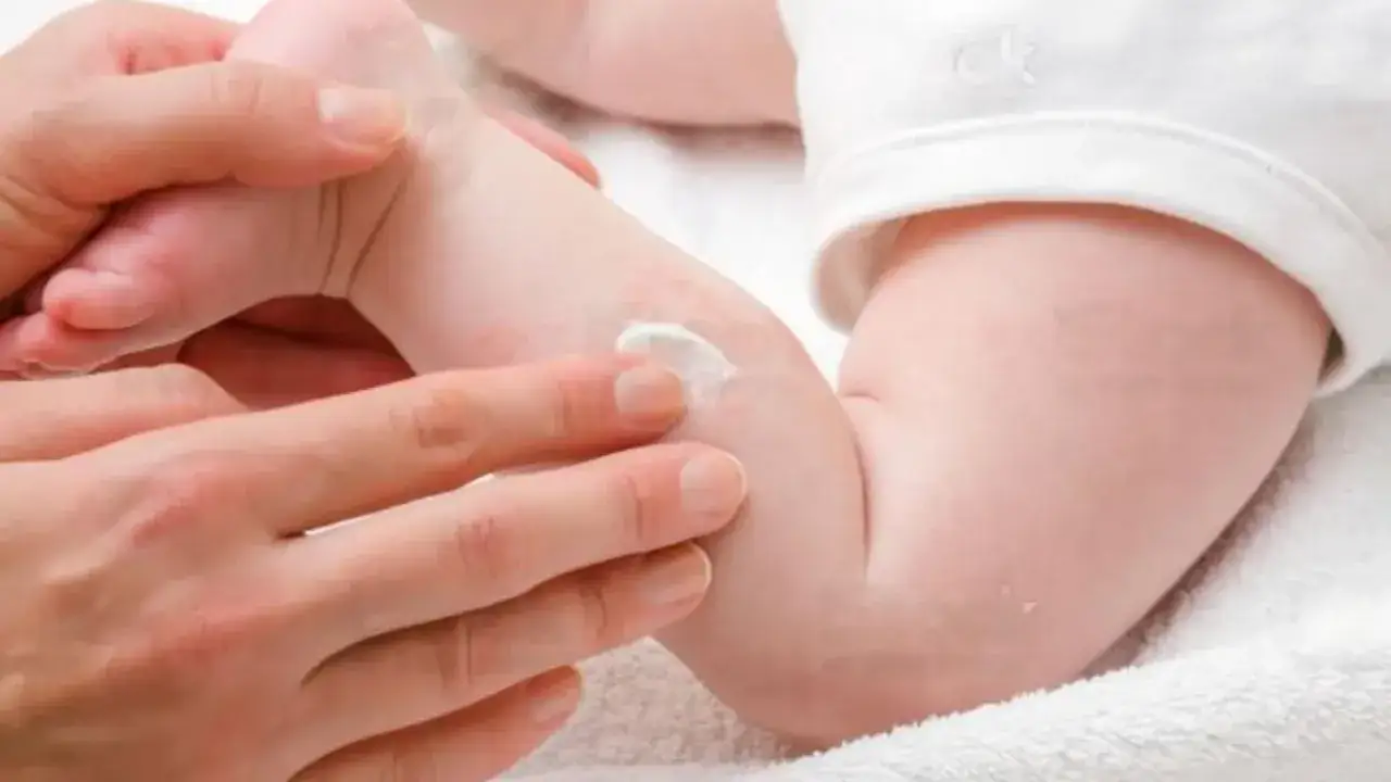 Manos aplican crema en la pierna de un bebé con sudamina.