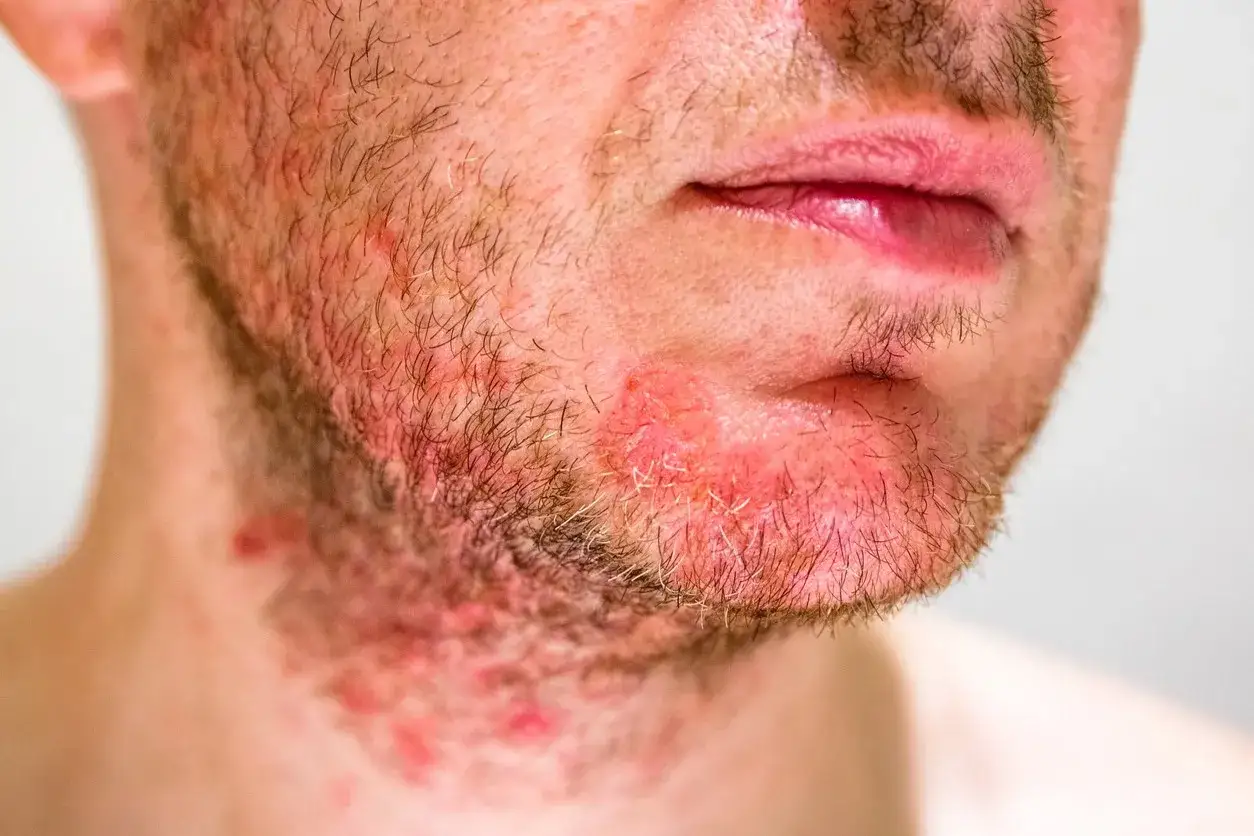 Primo piano del viso di un uomo con arrossamento e irritazione, indicativi di dermatite pelle secca.