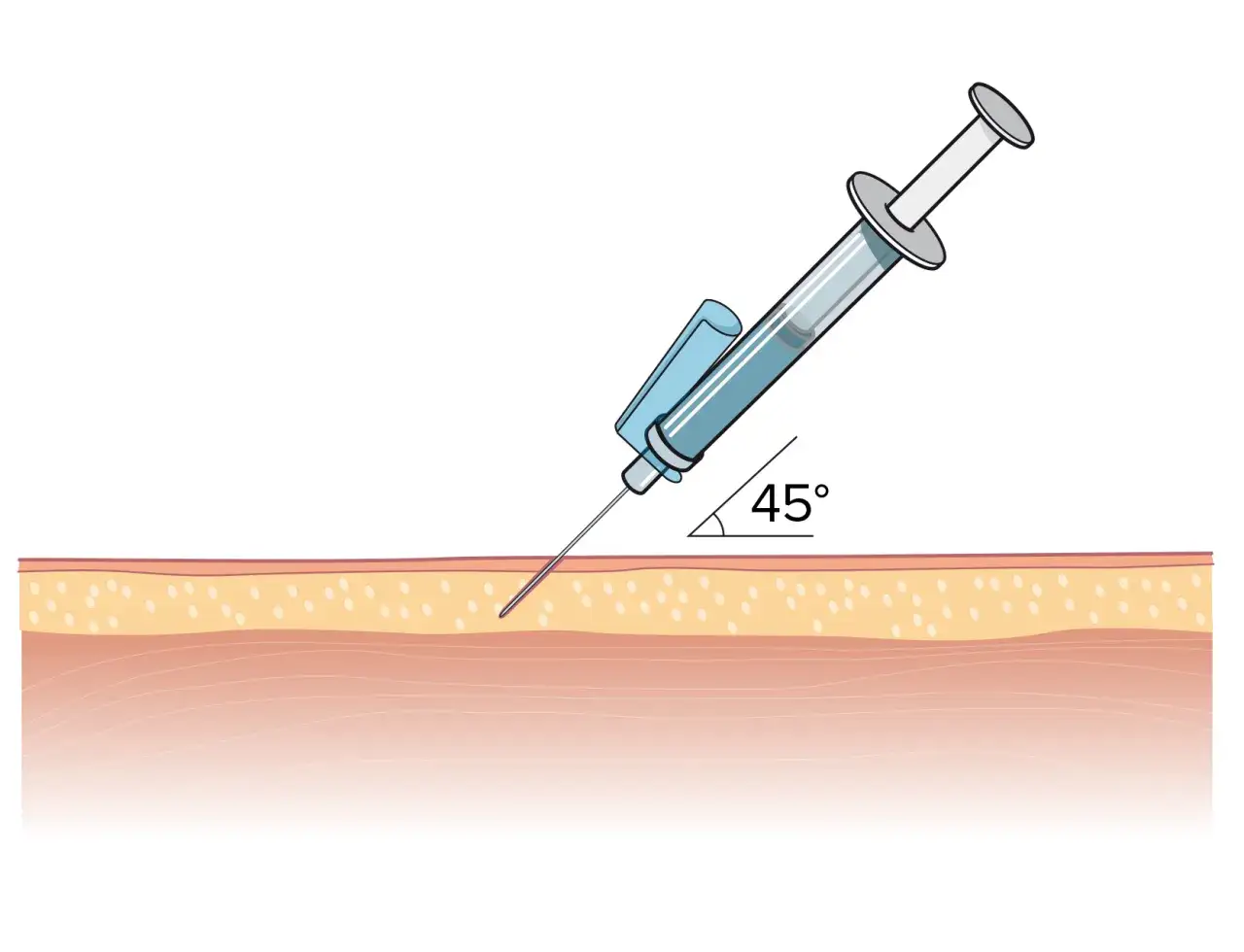 Spruta med vaccin injiceras i huden i 45 graders vinkel. En viktig del av att skydda sig, oavsett ålder, som vaccin 30 år kan vara en del av.