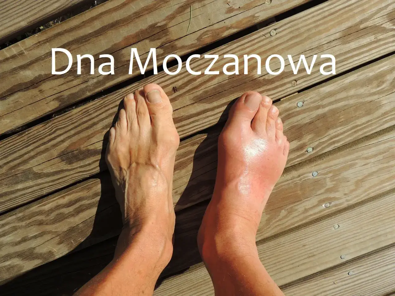 Dna moczanowa objawia się obrzękiem i zaczerwienieniem stopy, w przeciwieństwie do zdrowej.