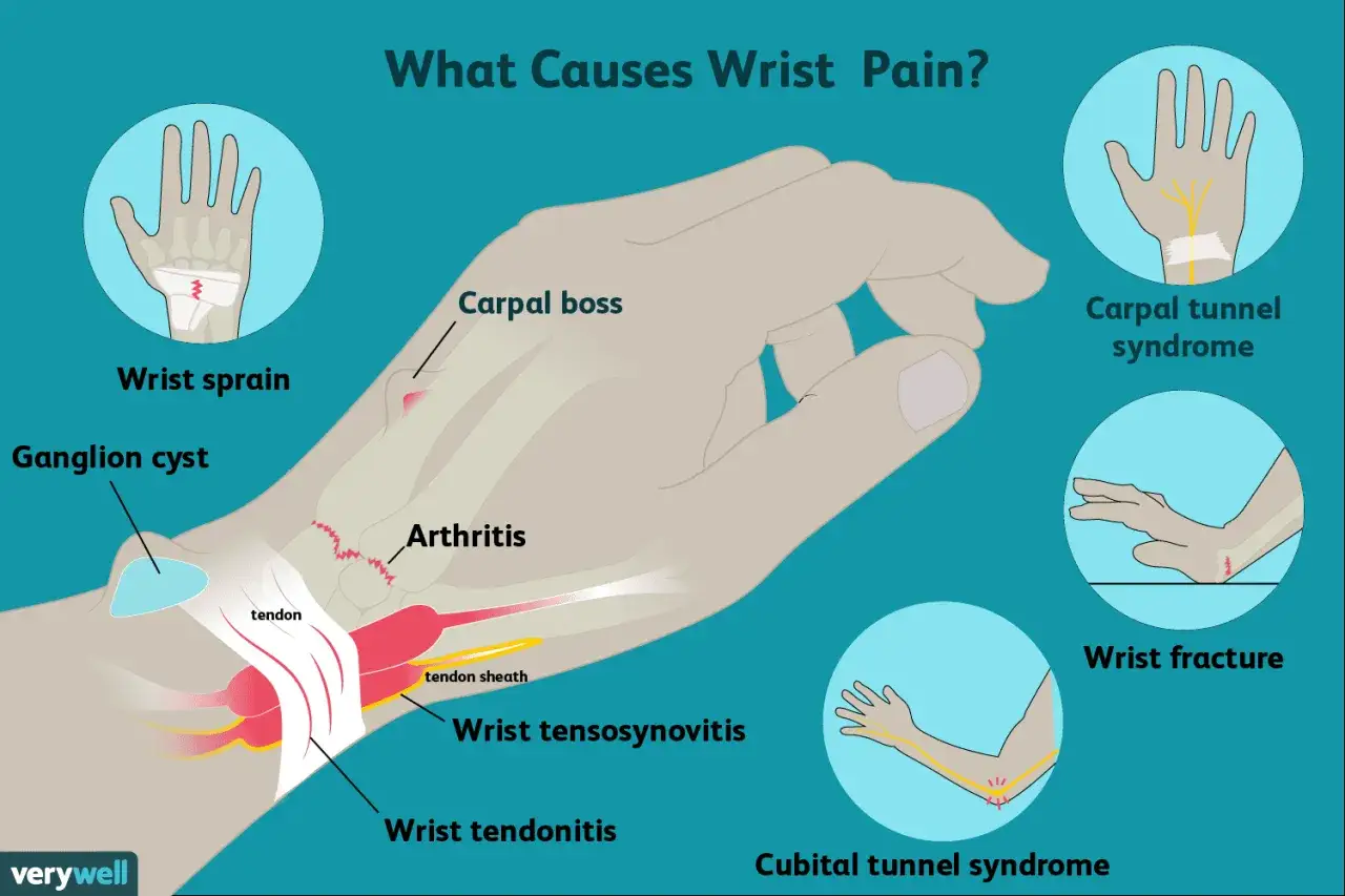 Illustration zeigt Ursachen für Handgelenkschmerzen, wie Arthritis oder Sehnenscheidenentzündung, die bei Drehbewegungen einen stechenden Schmerz im Handgelenk verursachen können.
