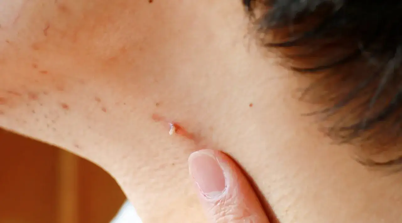 Dermatolog usuwanie brodawek: palec wskazuje na niewielką zmianę sk&oacute;rną na szyi, sugerującą zabieg.