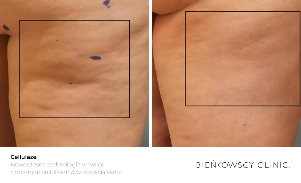 Przed i po zabiegu Cellulaze: widoczna poprawa skóry. Sprawdź, jaka jest liposukcja laserowa cena i pozbądź się cellulitu.