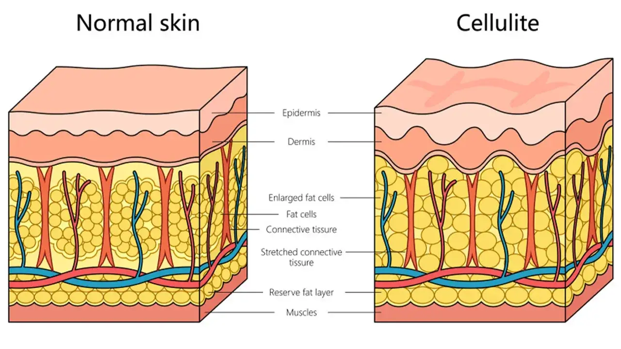 Confronto tra pelle normale e cellulite: la differenza &egrave; nell'adipe e nel tessuto connettivo.
