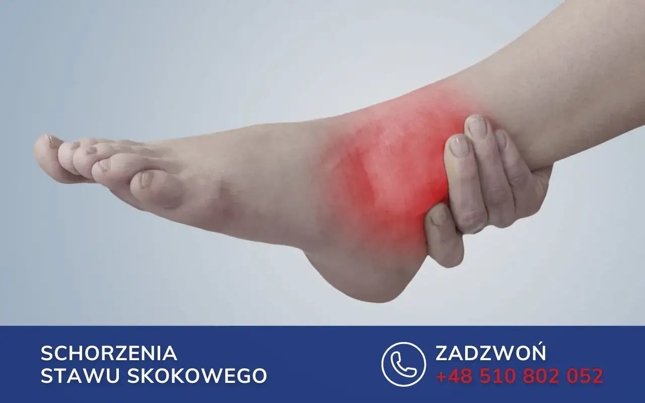 Obrzęk i zaczerwienienie wokół kostki, wskazujące jak wygląda złamana kostka. Dłoń uciska bolące miejsce.