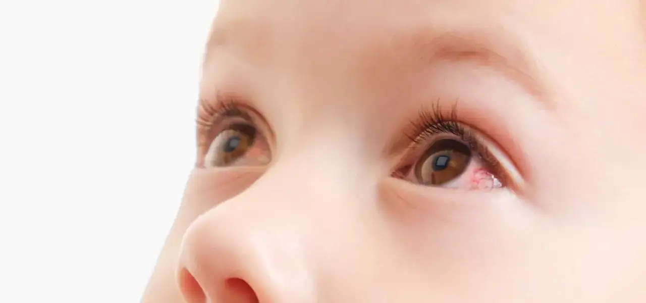 Primer plano de los ojos de un bebé, uno de ellos muestra irritación y vasos sanguíneos rojos.