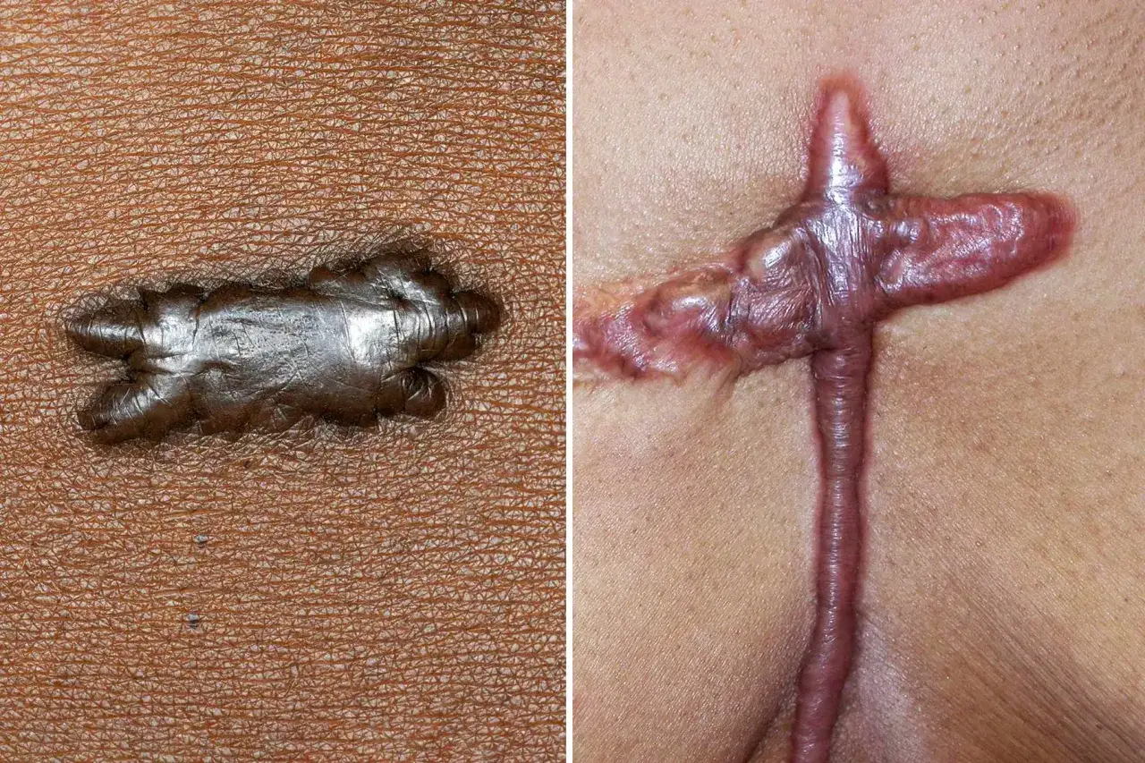 Confronto tra una cicatrice cheloide e un'altra che mostra possibili rimedi.