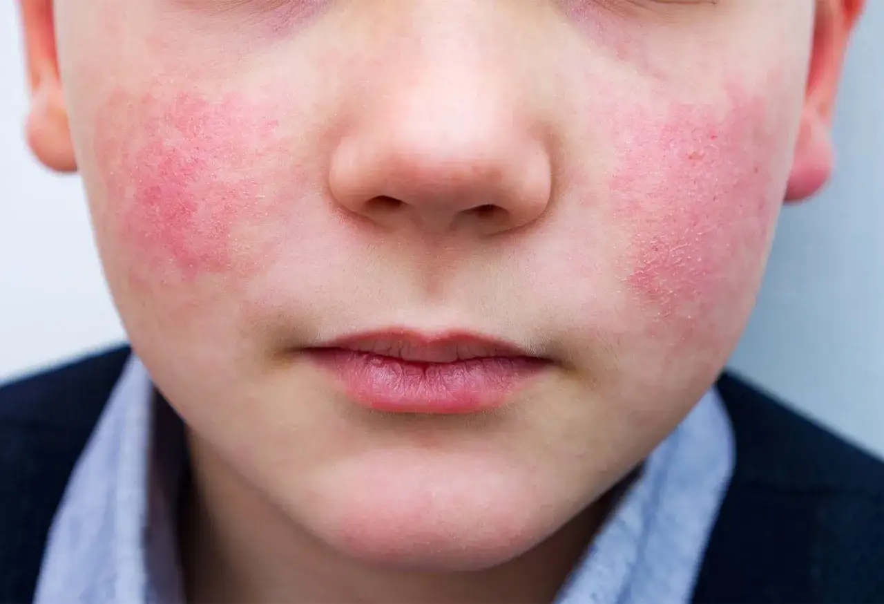 Primo piano del viso di un bambino con guance rosse e calde, forse per il freddo o un'allergia.