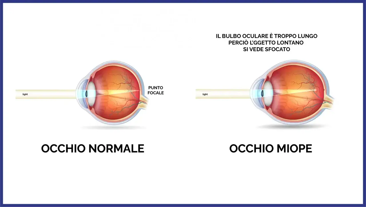 Confronto tra occhio normale e occhio miope. Nella miopia d'indice, il bulbo oculare &egrave; troppo lungo, causando una visione sfocata degli oggetti lontani.